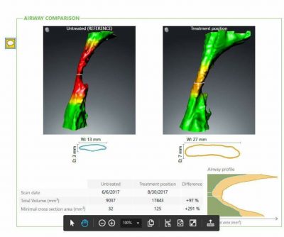 3D visual of Nightlase opening the airway