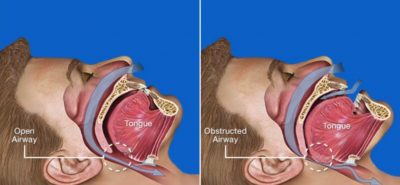 snoring is caused by a blocked airway
