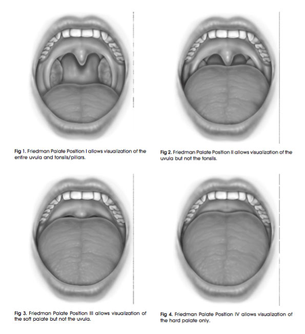 snoring Friedman tongue position test