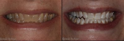 Deep Bleaching Teeth Whitening