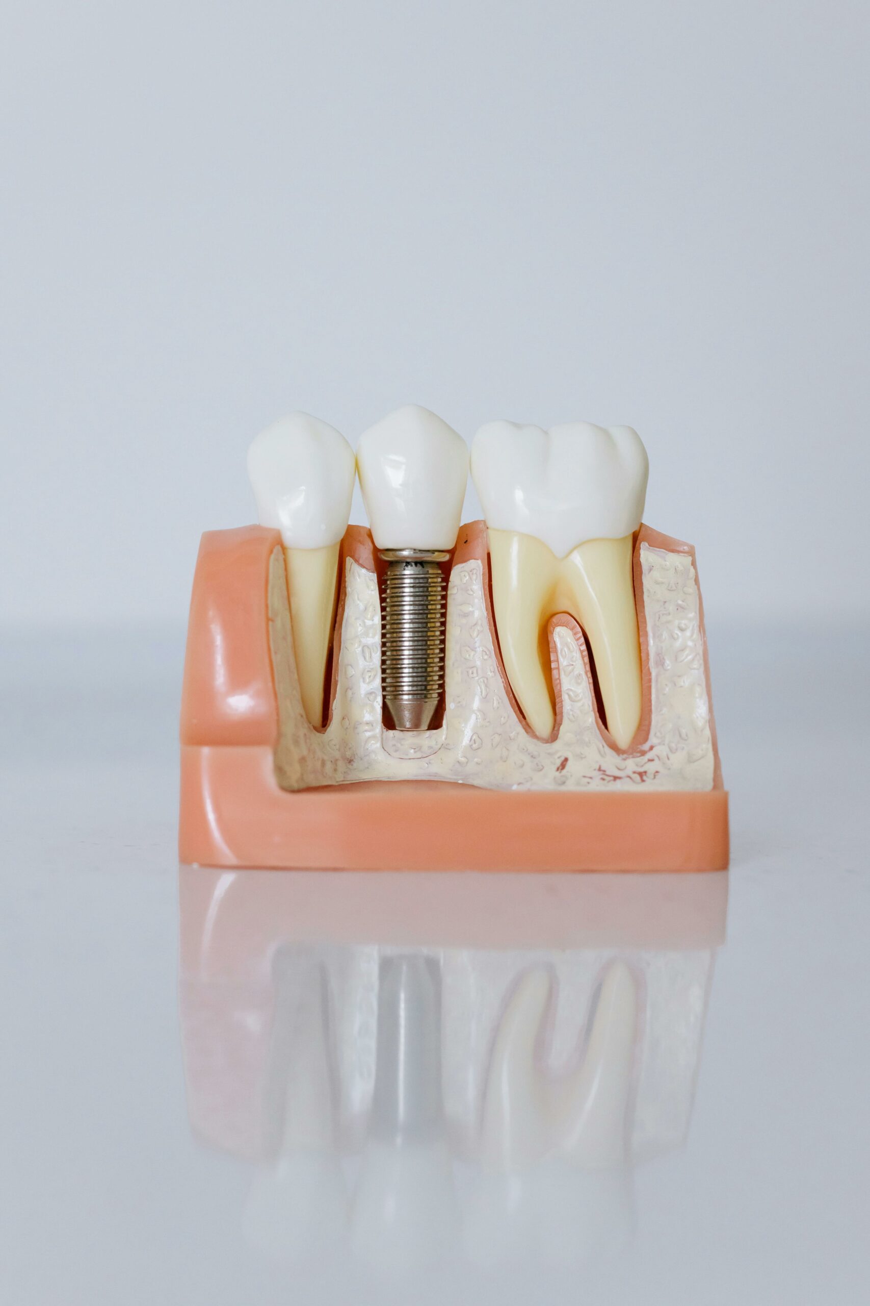 How much do dental implants cost in Charlotte NC?