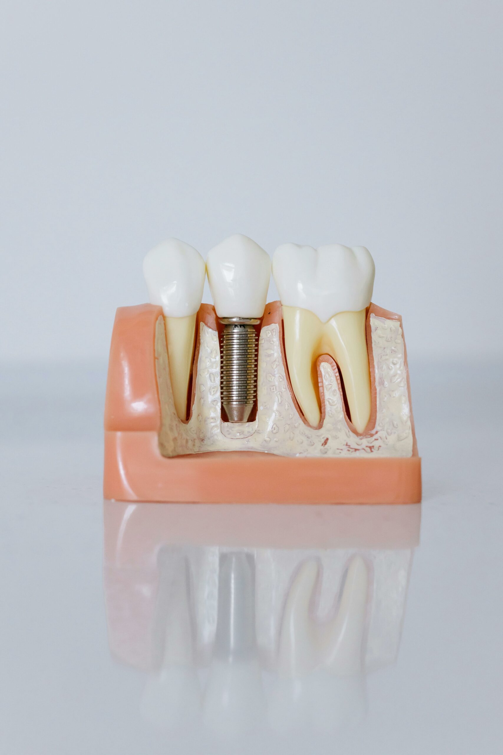 dental implant