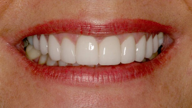 Dental Veneers