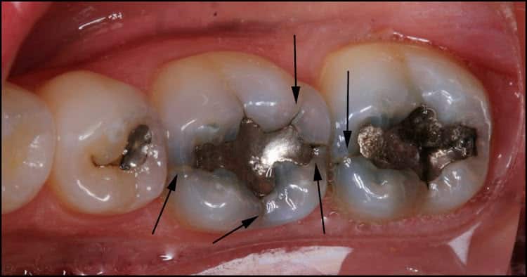 how does it feel if your tooth is cracked